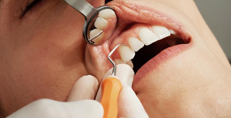 Close-up of a woman's teeth being examined by a dentist